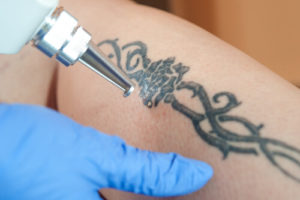 Tattoo Removal accident